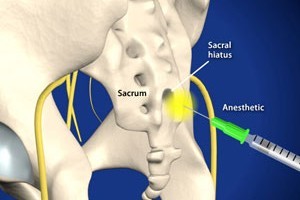Caudal Spinal Epidural Injection